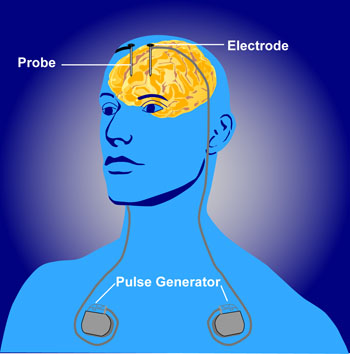 https://www.nimh.nih.gov/images/health-and-outreach/mental-health-topic-brain-stimulation-therapies/dbs_60715_3.jpg