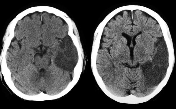 CT scan of stroke: http://1.bp.blogspot.com/-I5AIwDp1jJM/UF9gqPEw4vI/AAAAAAAB77M/VfLRw2JDEiY/s1600/mca+inferior+division+infarct+ct+brain.JPG